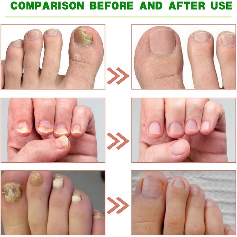 Ginger Nail, Tratamiento de Uñas con Jengibre, Soporte para Uñas,