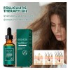 Aceite De Foliculitis Del Cuero Cabelludo, Natural Y Nutriti