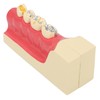 Right Lower Posterior Tooth Model 2X Magnification Detachable Resin Tooth