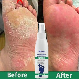 Foot Spray with Tea Tree Oil, Foot Care Dry Feet Plantar Moisturizing Deodorant, Advanced Foot and Nail Spray - Specification: 2pcs