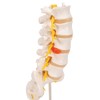 3B Scientific A76/5 Lumbar Spinal Column with Dorso-Lateral Prolapsed Intervertebral