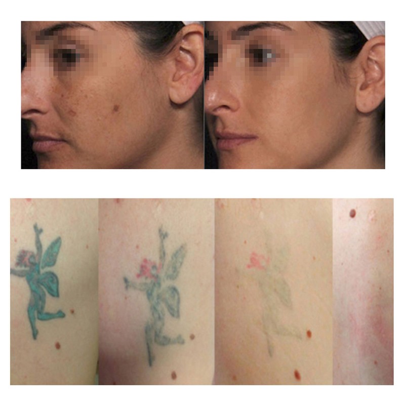 Blue Light Picosecond Pen Scar Tattoo Removal Pen For Melanin