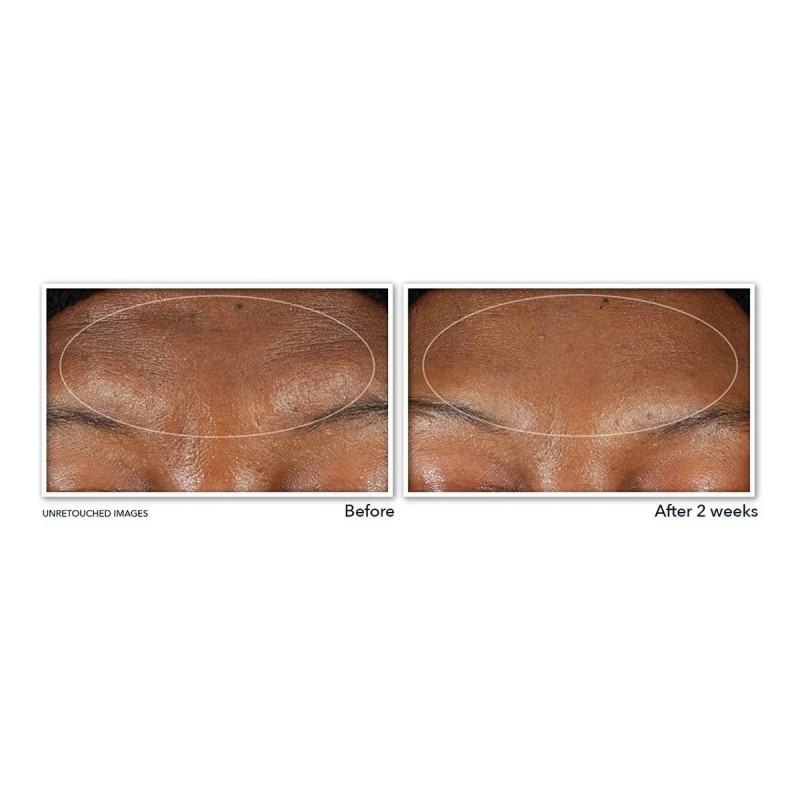 Roc Retinol Correxion-limpiador Facial De Suero De Arrugas