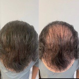 Keratin Hair Building Fibers Dark Brown 115g Refill Hair Loss Cover Save 40%