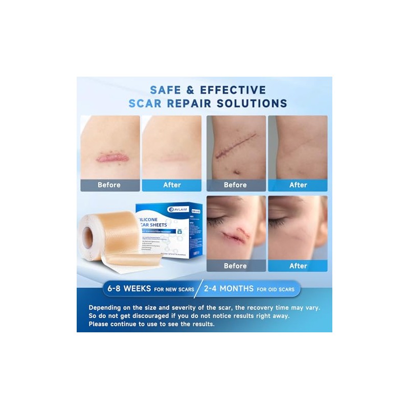 Rvlaim Silicone Scar Sheets for Effective Scar Treatment