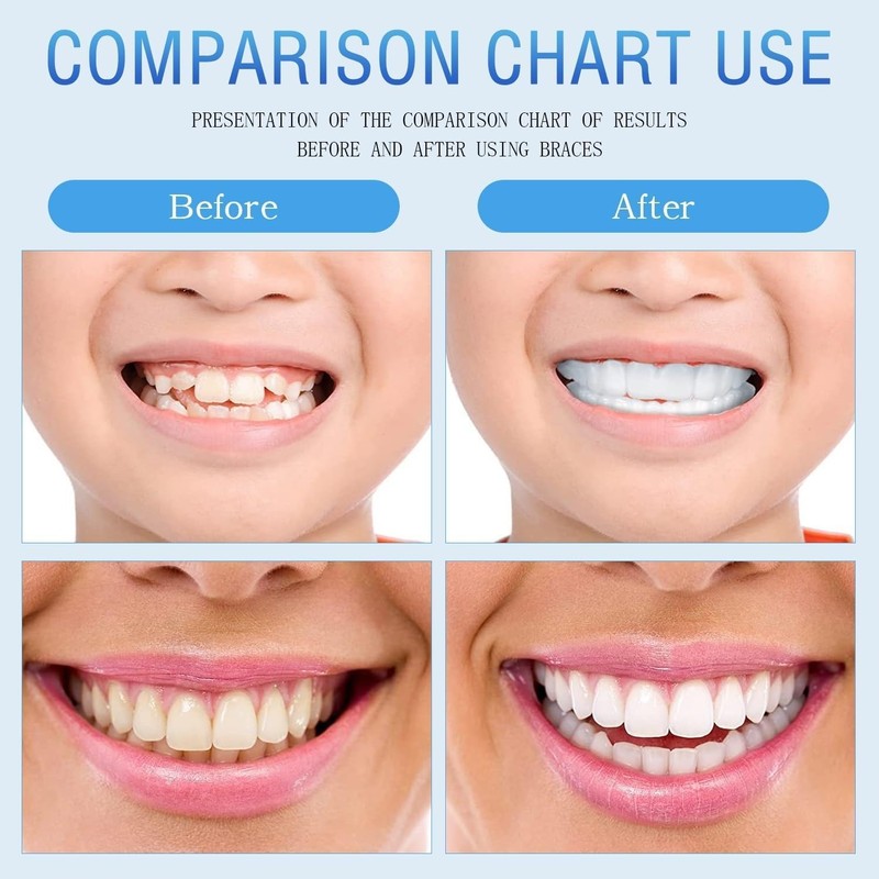 2 Pairs Beginner-Friendly Smile Tuning Kit, Tool-Free Shaping, Reusable Universal