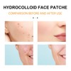Face Acne Patches Hydrating and Purifying Forehead Nose Chin Cheek