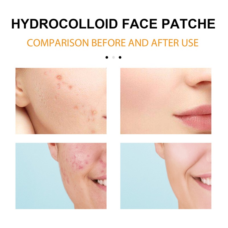 Face Acne Patches Hydrating and Purifying Forehead Nose Chin Cheek