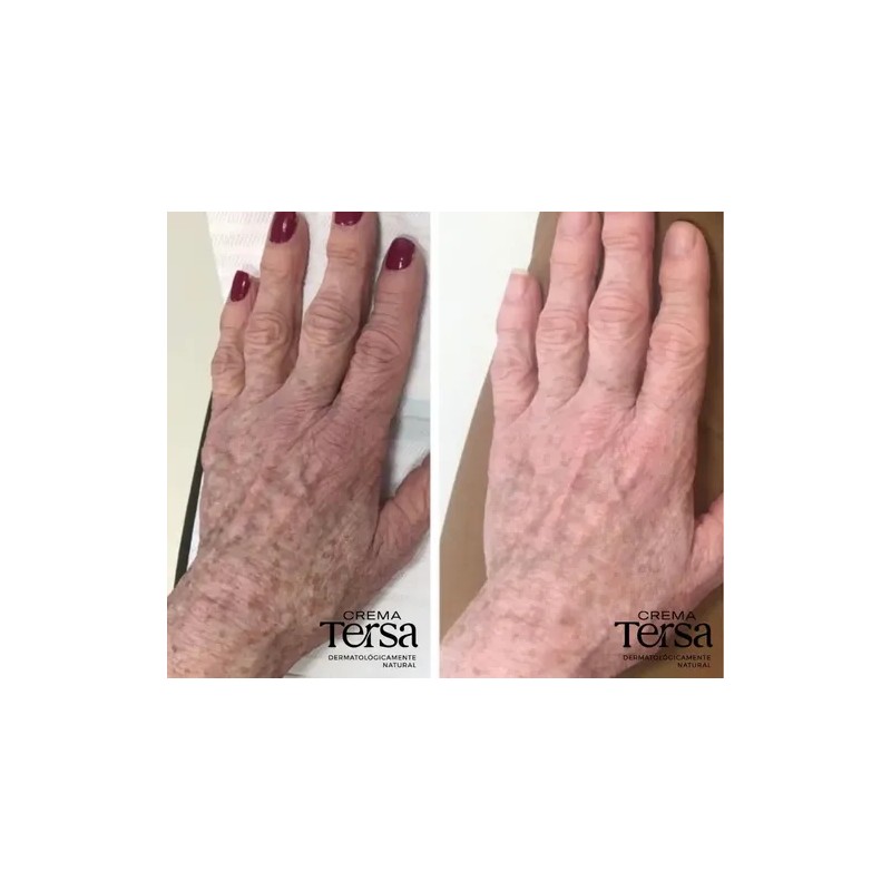 Crema Tersa Despigmentante Quita Manchas Acné Paño De 40g