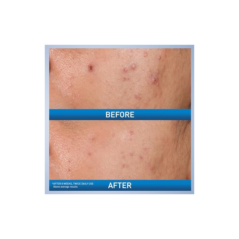 CeraVe Gel para Acné con Ácido Salicílico 3 Ceramidas
