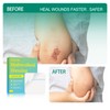 Hydrocolloid Bandage 10 Pack, 4''x4'' Thin Sterile Hydrocolloid Wound Dressing