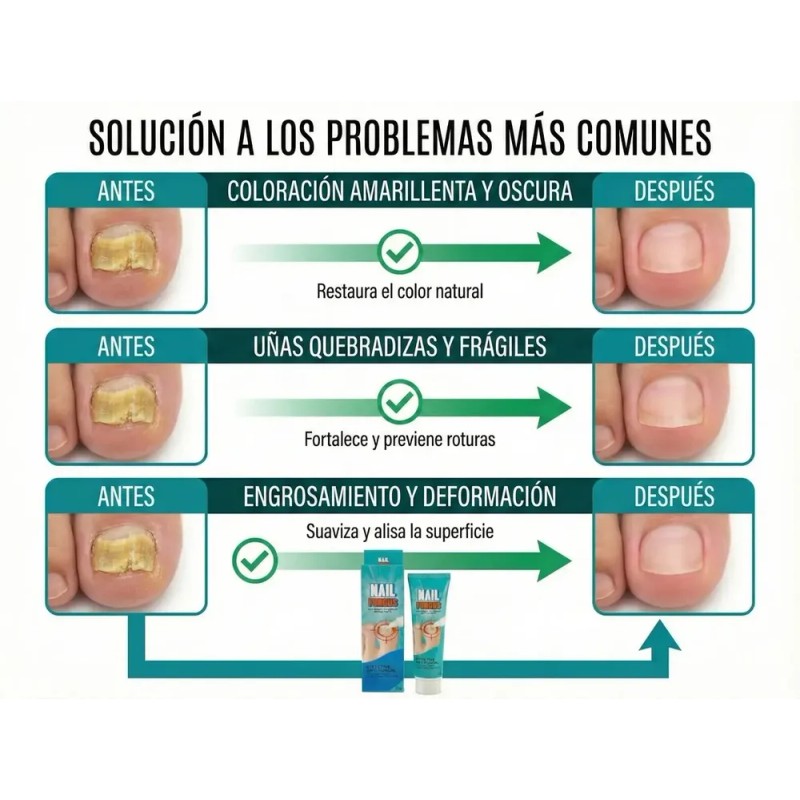 Tt/ Crema Fungicida Para Hongos En Uñas Y Piel De
