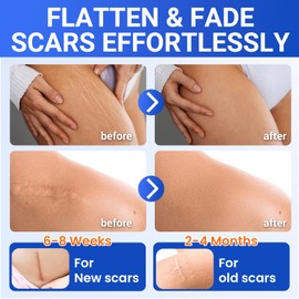 Silicone Scar Sheets Medical Grade Tape (1.6"x150" Roll) Healing Patches for C-Section, Keloid, Face Wrinkles, Stretch Marks, Surgical Recovery, Professional Scar Cover for Sensitive Skin, Soft Tissue