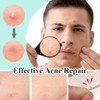 600pcs Pimple Patches Hydrocolloid Acne Stickers Spot Cover Patches