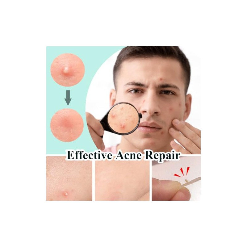 600pcs Pimple Patches Hydrocolloid Acne Stickers Spot Cover Patches