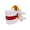 Human Anatomical Lumbar Disc Herniation Model, 1.5X Life-Size Herniated Lumbar