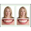 Dr. Bailey's Secure Instant Smile Upper -One Size Fits Most