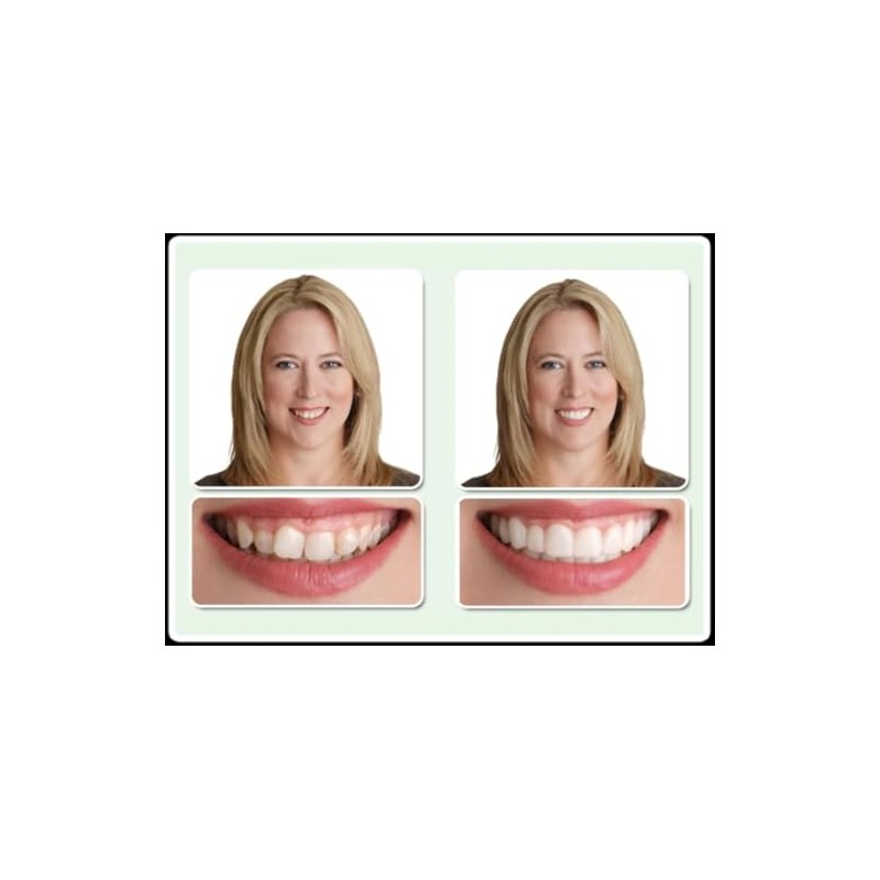 Dr. Bailey's Secure Instant Smile Upper -One Size Fits Most