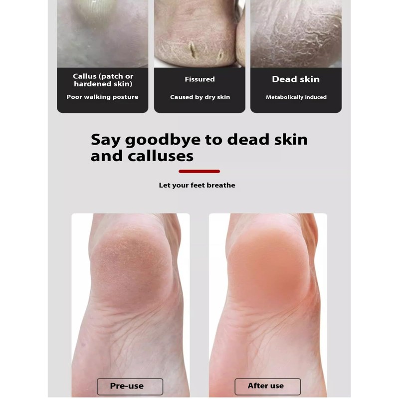 2PCS Foot Scrubber Hard Skin, Foot File & Pumice Stone