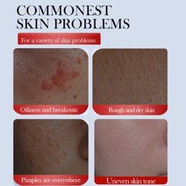 2PCS Anti-Freckle & Anti-Acne Face Cream Set – Dark Spot Corrector and Spot Treatment Cream – Brightening, Hydrating & Blemish Care for Clear Skin Facial Moisturizer with Vitamin C, Salicylic Acid