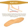 Vaya Deluxum Orthopaedic Insoles Supination for Transverse and Longitudinal Flat