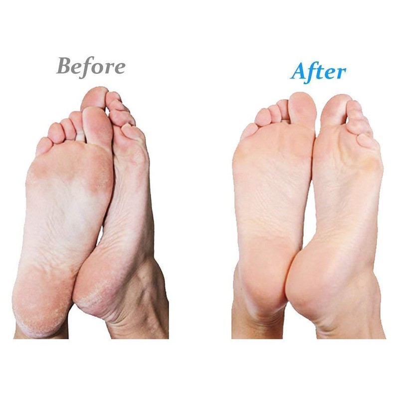 Emjoi Micro-Pedi Ultra Callus Remover (Pink)