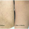 Keratosis Pilaris Body Wash – Targets Bumpy Skin, Strawberry Legs
