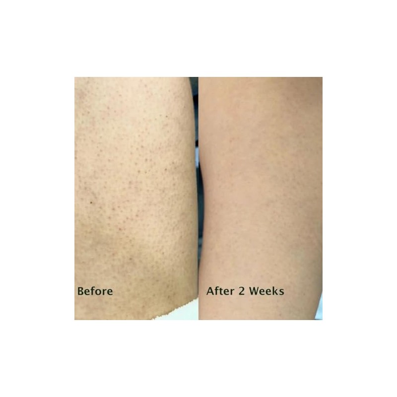 Keratosis Pilaris Body Wash – Targets Bumpy Skin, Strawberry Legs