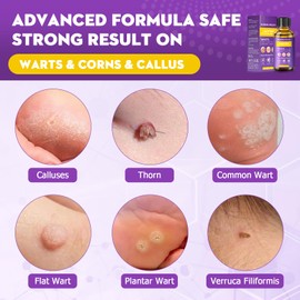 Wart Remover, Fast Acting Verruca Treatment for Hands and Feet, Effective Skin Tag Removal Kit, Gentle Treatment for Common Warts, Plantar Warts, Corns & Calluses (30ML)