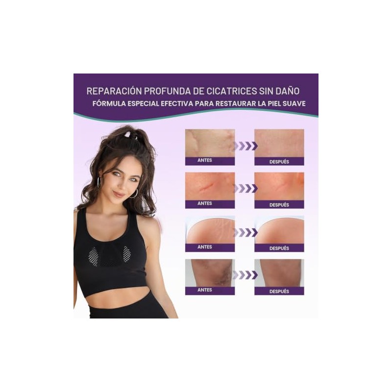 Crema Silicona Cicatrices Gel Tratamiento Avanzado Eliminar Estrías Antiguas Recientes