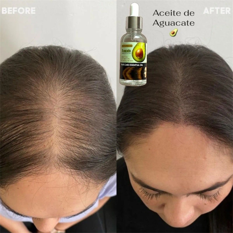 Hair Care Aceite De Aguacate Para Crecimiento De Cabello