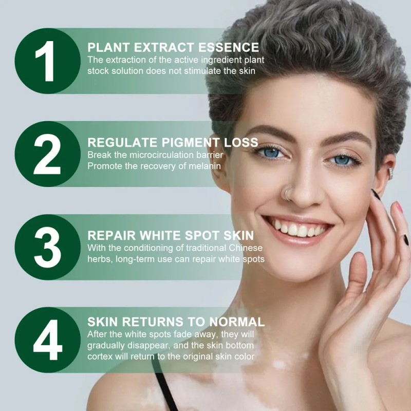 Vitíligo Aceite White Vitíligo Para 4×crema T