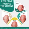Pack of 50 Toenail Correction Patches for Ingrown Toenails -