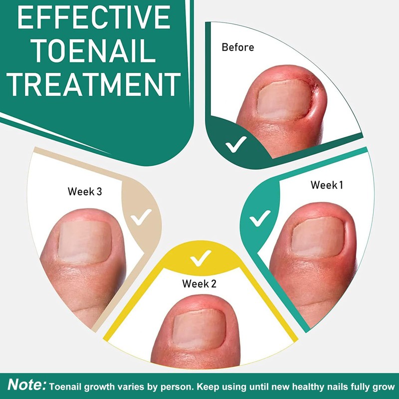 Pack of 50 Toenail Correction Patches for Ingrown Toenails -