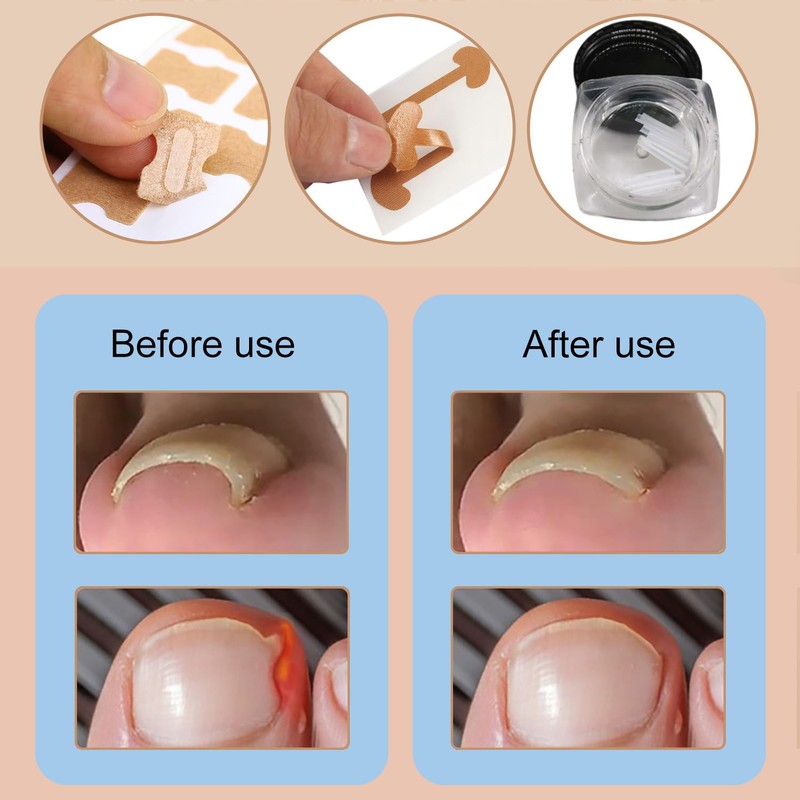 Set Zur Korrektur Eingewachsener Zehennägel,Ingrown Zehennagel Korrektur Set Mit 105
