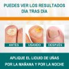 Ungüentopara Hongo De Uñas Elimina Eficazmente Los Hongo