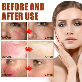 2PCS Rosacea Face Serum,Anti Redness Face Serum,Tea Tree Anti Aging Serum for Face,Relieve Redness & Acne Mark,Natural Face Moisturizer for Sensitive Skin,Improve Skin Elasticity-Women & Men