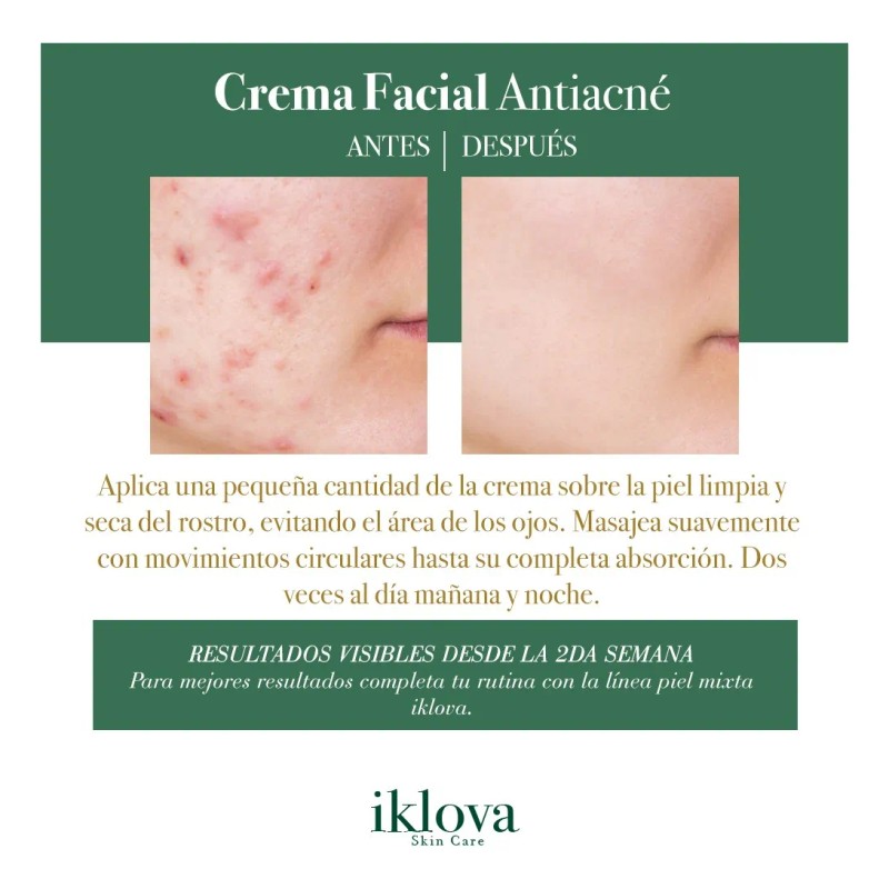 Crema Anti Acné Piel Mixta Iklova