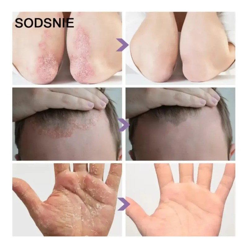 2×crema For La Psoriasis Y El Cuidado De La Piel