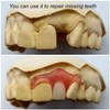 Gum Material - for Repairing Missing Teeth and Smile Improvement.
