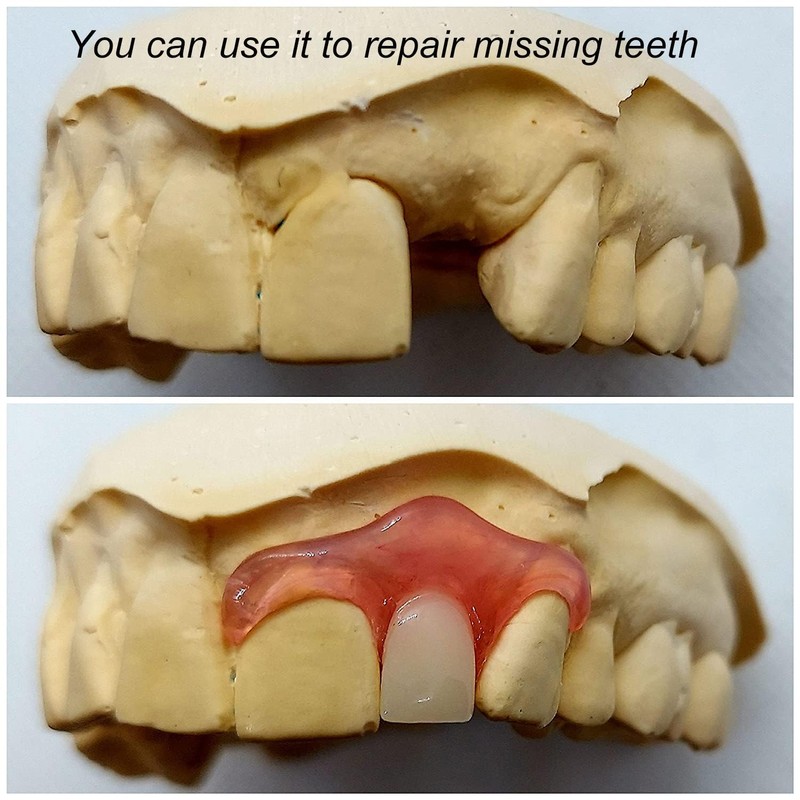 Gum Material - for Repairing Missing Teeth and Smile Improvement.