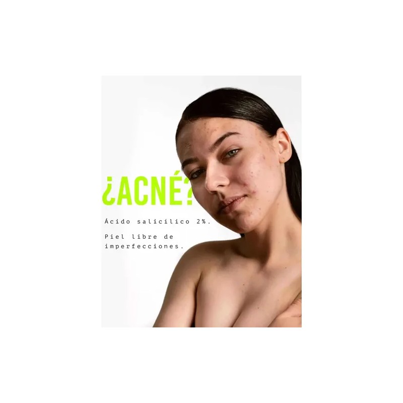 Serum Sebo, Tratamiento Control Y Eliminación Deacné.