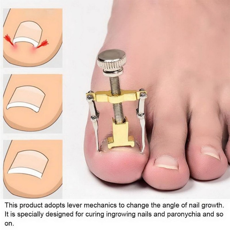 2 Piece Set Ingrown Toenail Correction Strips Brace Kit Ingrown