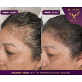 1 Shampoo Anticaída Y Crecimiento Chile Y Romero Vital Root                                                                                           