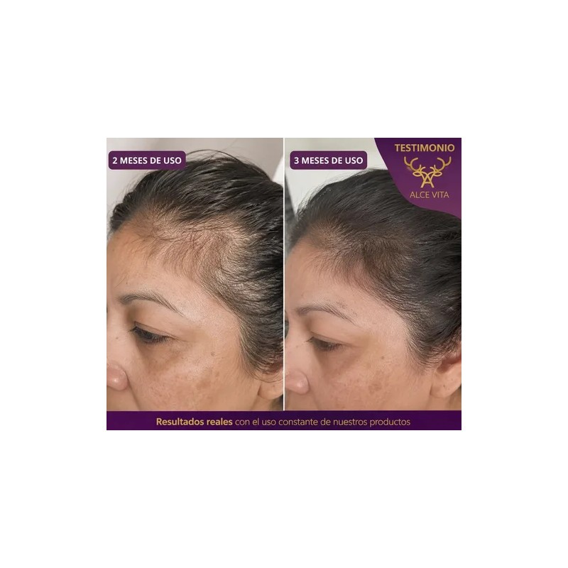 1 Shampoo Anticaída Y Crecimiento Chile Y Romero Vital Root