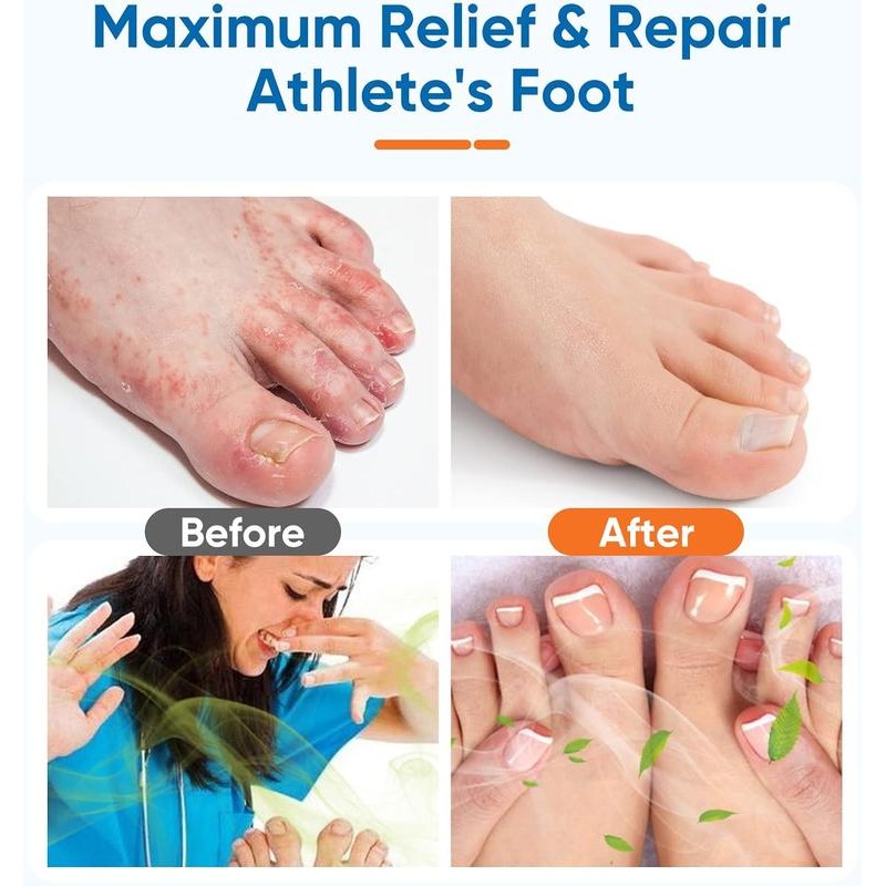 Tea Tree Oil Foot Spray for Dry, Cracked Heels –