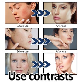 Acne Foam Wash,Acne Foaming Wash - Gentle Daily Cleansing Foam for Deep Pore Cleansing,Moisturising Face Wash for Women & Men,Exfoliating Face Wash,Foaming Cleanser for Oily & Acne-Prone Skin