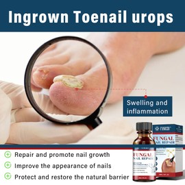 30ml Nail Treatment, Fast Extra Strong Nail Repair Solution, Nail Treatment Serum, Repair for Damaged Discolored Thick Nail, Repairs and Renew Damaged, Broken, Cracked & Discolored Nails