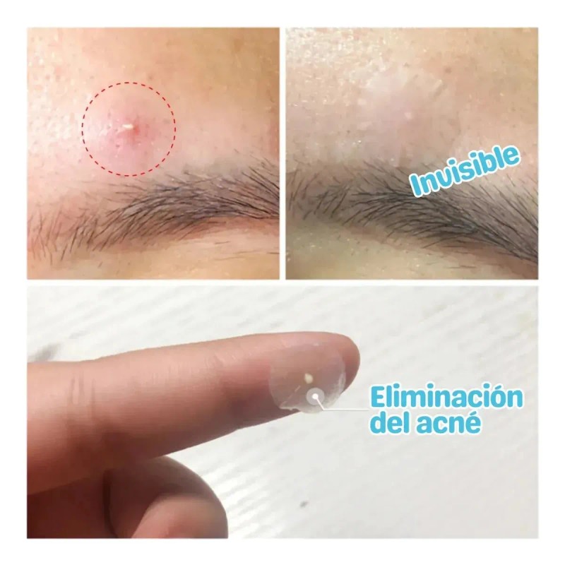 🔥 Parches dia/ noche quita espinillas tapa acné set 3