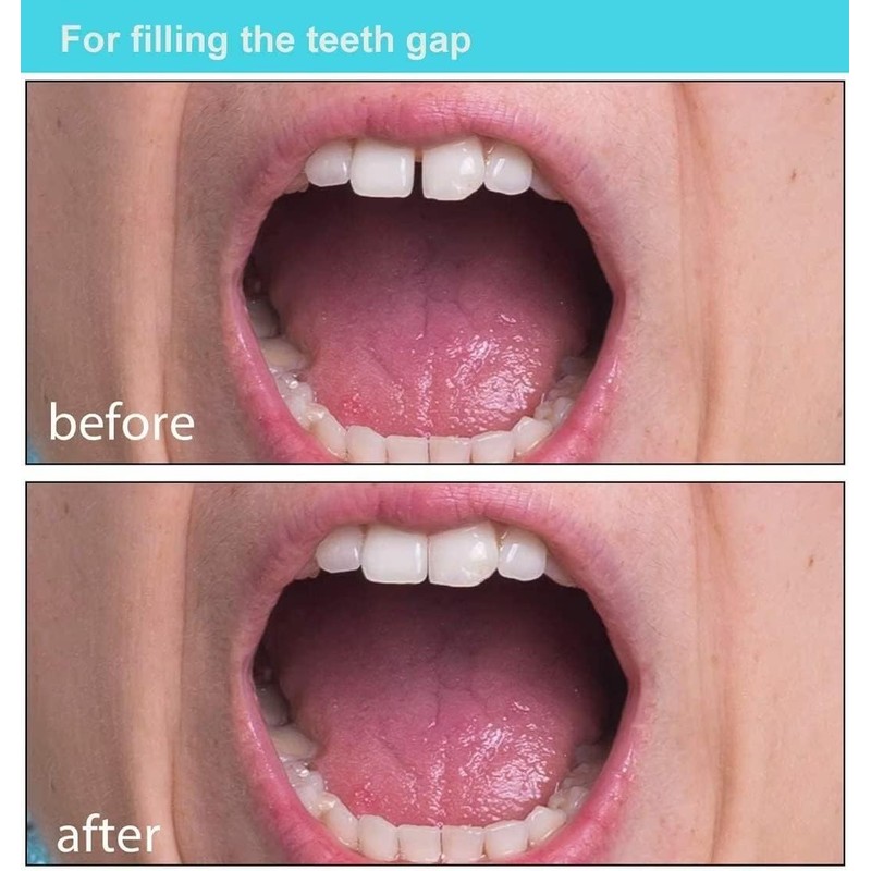 Fake Tooth Repair Kits DIY Dental Care Kit Glue for